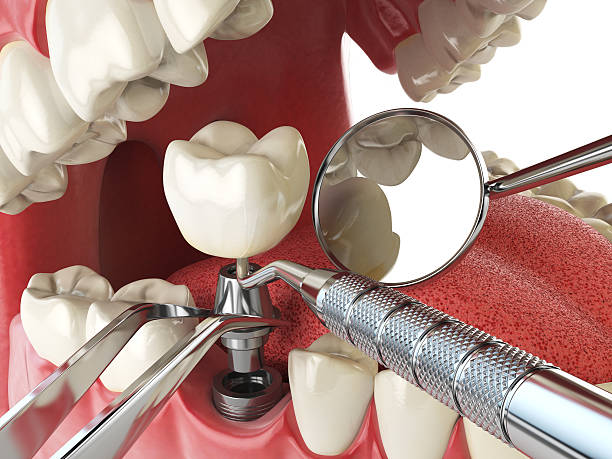 Best Emergency Broken Tooth Repair in Valparaiso, FL